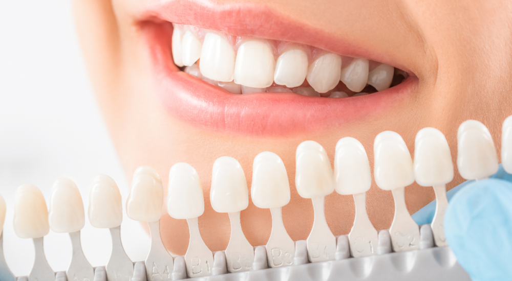 teeth-whitening-at-home-london